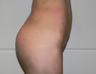 Buttock implants
