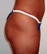 Buttock Augmentation