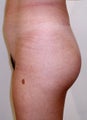 Buttock Enhancement