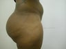 Butt Implants