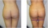 Buttock Augmentation