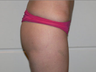 Buttock implants