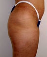 Buttock Augmentation