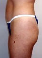 Buttock Enhancement