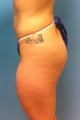 Gluteal Implants