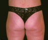 Buttock and flank lift for massive weight loss