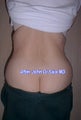Butt Lift Years Following Tummy Tuck