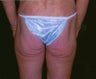 Buttock and flank lift for massive weight loss