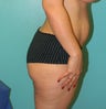 Brazilian Butt Lift- Fat transfer