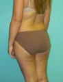 Brazilian Butt Lift- Fat Transfer