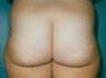 Butt lift