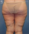 Backlift