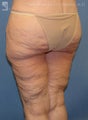 Backlift