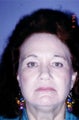 Co2 Laser (skin resurfacing)