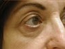 Fractional CO2 Laser Resurfacing - The Madonna Lift