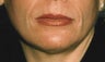 Perioral CO2 Laser Resurfacing