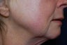 Fractional CO2-Total FX Wrinkle Treatment