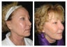 CO2 and Injections