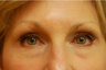 Fractional C02 Laser