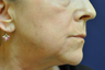 Fractional C02 Laser