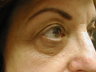 Fractional CO2 Laser Resurfacing - The Madonna Lift