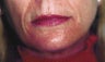 Perioral CO2 Laser Resurfacing