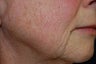 Fractional CO2-Total FX Wrinkle Treatment