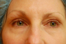 Fractional C02 Laser