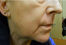 Fractional C02 Laser