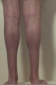 Calf implants