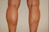 calf implants