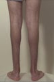 Calf implants