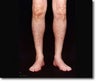 Calf Implant