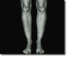 Calf Implant