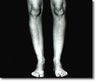 Calf Implant