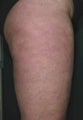 Cellulite treatment