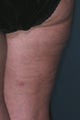 Cellulite treatment