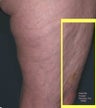 Cellulite treatment