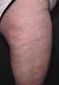 Cellulite treatment