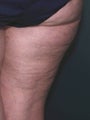 Cellulite treatment