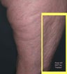 Cellulite treatment