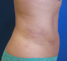 Cellulite Treatment