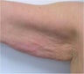Accent for Cellulite Treatment