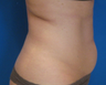 Cellulite Treatment