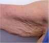 Accent for Cellulite Treatment