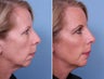 Radiesse, Cheek & Chin Augmentation
