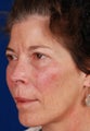 Radiesse Cheek Augmentation