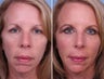 Radiesse, Cheek & Chin Augmentation
