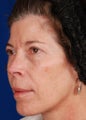 Radiesse Cheek Augmentation