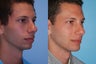 Chin Implant Augmentation